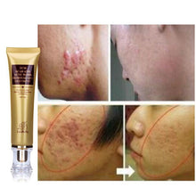 2Pcs Acne Scar Remover Cream - 60%OFF!
